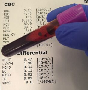 COMPLETE BLOOD PICTURE OR CBP , CBP