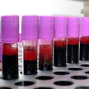 Adenosine Deaminase (ADA) – Serum