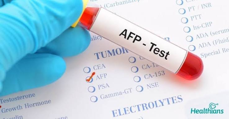 Alpha-Fetoprotein (AFP) – Amniotic Fluid