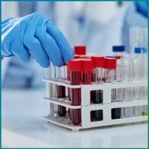 Absolute Lymphocyte Count (ALC)