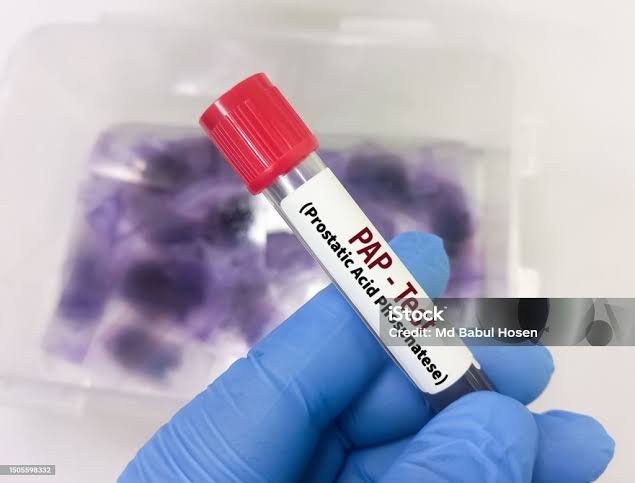 Prostatic Acid Phosphatase (PAP) – Serum